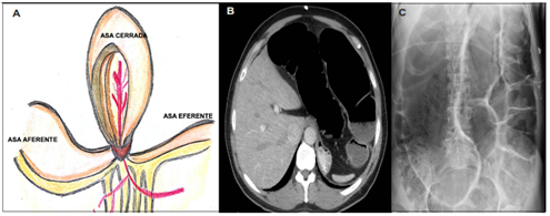 Representación esquemática y radiológica de obstrucción en asa cerrada. A. En la obstrucción en asa cerrada el lumen intestinal es obstruido en dos sitios localizados uno cerca al otro en los puntos de entrada y salida del asa; B. Corte axial de una tomografía de abdomen de un paciente con diagnóstico de vólvulo del sigmoide; C. Radiografía de abdomen de paciente con obstrucción intestinal con relación a vólvulo del sigmoide, se evidencia importante distensión de asas intestinales.