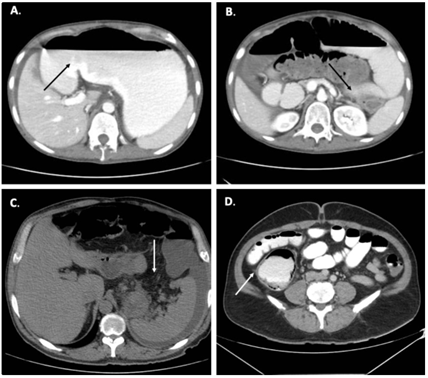 A-B. Dilatación de las asas intestinales delgadas con una zona de transición en el íleon terminal en la pelvis compatible con obstrucción mecánica. C. Distensión del ciego y colon ascendente con neumatosis y edema mesentérico asociado D. Tomografía de abdomen con evidencia de líquido libre.