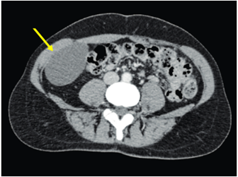 Tomografía computarizada de abdomen donde se aprecia una lesión quística (flecha amarilla), de localización aparentemente extracompartimental, con medidas de 55 x 65 x 85 mm, en íntima relación con el músculo transverso del abdomen derecho, que desplaza el colon ascendente.