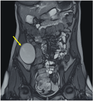 Resonancia magnética nuclear del abdomen con contraste (enteroRMN). En flanco y fosa iliaca derechos se identifica una formación quística unilocular (flecha amarilla) retroperitoneal (76 mm craneocaudal, 66 x 42 mm), sin componente infiltrativo, que determina discreto desplazamiento medial del colon ascendente en su tercio medio, localizándose inferior y alejada del riñón ipsilateral.