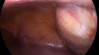 Abordaje laparoscópico donde se observa la tumoración quística a tensión, con contenido gelatinoso de apariencia mucoide espeso, amarillento, ubicada en pared abdominal de flanco y fosa ilíaca derechos, entre el músculo transverso y el peritoneo parietal anterior.