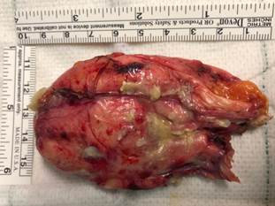 Aspecto macroscópico de pieza quirúrgica extirpada. Teratoma maduro.