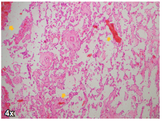 Corte del angiosarcoma de mama de la paciente, donde se aprecian los canales vasculares anastomosados (flechas amarilla). Tincion de hematoxilina y eosina 4x.