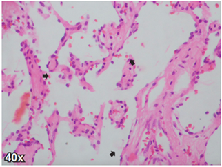 Corte del angiosarcoma de mama de la paciente, donde se observan celulas endoteliales con hipercromasia nuclear leve (flechas negra). Tincion de hematoxilina y eosina 40x.
