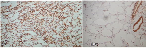 Marcador de inmunohistoqumica CD31 y ERG del angiosarcoma de mama de la paciente.