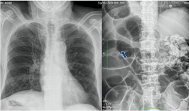 Radiografía de tórax (izquierda) donde se aprecia la ubicación cardíaca habitual. Radiografía de abdomen (derecha) con marcada dilatación de marco cólico (flecha) y ausencia de gas en ampolla rectal.