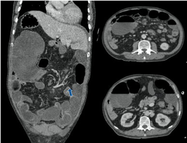Tomografía de abdomen que permite visualizar el situs inversus, marcada dilatación de ciego en hipocondrio derecho y signo del remolino (flecha).