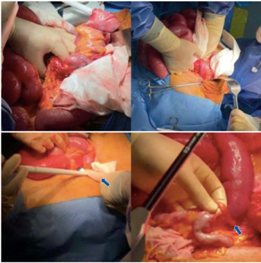 Imágenes intraoperatorias: apendicectomía, cecostomía aspirativa a través de base apendicular, resección ileocecal y anastomosis laterolateral (flechas).