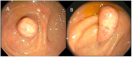 A. Se observa la punta del ap&eacute;ndice cecal. B. Vista lateral del ap&eacute;ndice invertido con cambios mucosos de tipo inflamatorio.