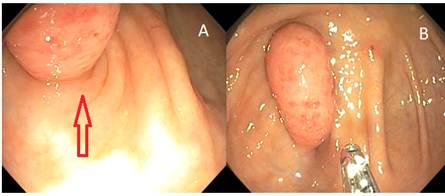 A. La flecha se&ntilde;ala el ostium apendicular. B. Se observa la punta de la pinza de biopsias, una de las caras laterales del ap&eacute;ndice y su base en relaci&oacute;n con el ostium apendicular.