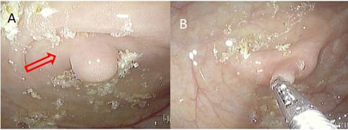 A. La flecha se&ntilde;ala el ostium apendicular y la imagen sugestiva de p&oacute;lipo, que realmente corresponde a la inversi&oacute;n del mu&ntilde;&oacute;n apendicular. B. La pinza de biopsias tracciona el mu&ntilde;&oacute;n apendicular, se observa la eversi&oacute;n del ostium apendicular.