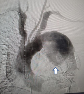 Aneurisma del arco aórtico roto, sin zona de anclaje proximal.