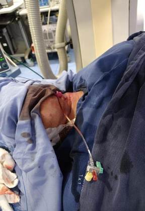 Abordaje percutáneo de arteria carótida común izquierda.