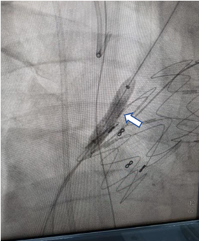 Prótesis Advanta® (cubierto) en la arteria carótida común izquierda.