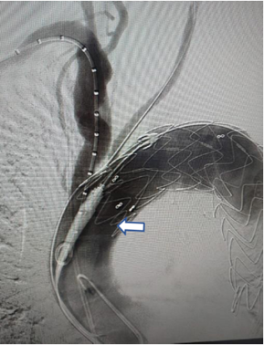 Exclusión completa del aneurisma y permeabilidad de la arteria carótida.