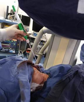 Cierre percutáneo con Angioseal.