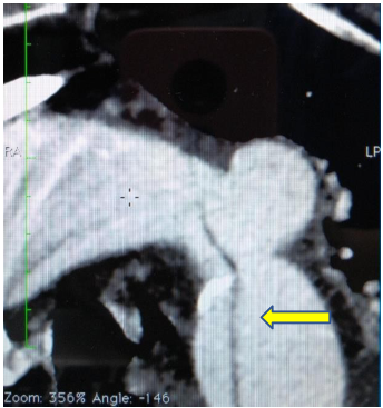 Angiotac con úlcera aortica y disección.