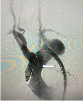 Angiografía sin zona de anclaje proximal.