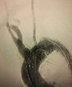 Exclusión completa del aneurisma y revascularización endovascular de la carótida izquierda y del tronco braquiocefálico.