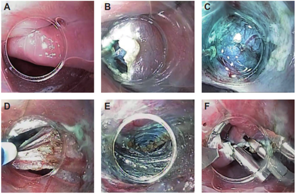 Im&aacute;genes del procedimiento endosc&oacute;pico. A, septo del divert&iacute;culo.  B, incisi&oacute;n en la mucosa. C, disecci&oacute;n del espacio submucosa. D, secci&oacute;n de fibras musculares del septo. E, miotom&iacute;a. F, cierre de la mucosa con clips. Fuente: elaboraci&oacute;n propia.