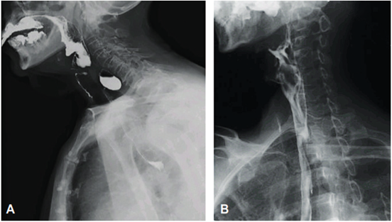 A, Esofagograma preoperatorio. B, Esofagograma posoperatorio. Fuente: elaboraci&oacute;n propia.