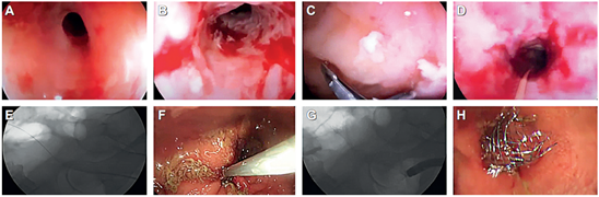 A. Estenosis de anastomosis colo-colónica en paciente con enfermedad de Crohn. B. Después de varias sesiones de dilatación con balón fallidas. C. Toma de biopsias para descartar malignidad. D. Paso de la guía a través de la estenosis no dilatable. E. Control fluoroscópico del paso de la guía. F. Paso del stent por la estenosis. G. Visión fluoroscópica de la liberación del stent. H. Aspecto endoscópico del stent liberado.