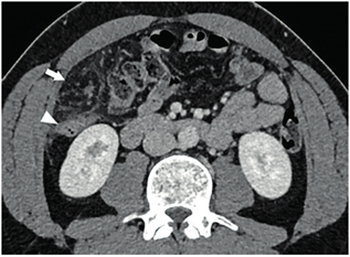 Tomografía de abdomen con contraste en fase venosa, corte axial, donde se observa a nivel de flanco derecho una alteración en la densidad del epiplón mayor, bien delimitada por un halo hiperdenso (flecha). Contacta hacia atrás con el colon ascendente, el cual presenta paredes discretamente engrosadas, de aspecto inflamatorio, desproporcionadamente menor a la alteración del epiplón (punta de flecha).