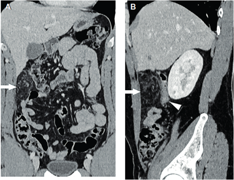Rreconstrucción en plano coronal (A) y plano sagital (B). Alteración bien circunscripta en el epiplón mayor a nivel de flanco derecho (flechas), que determina ligero efecto de masa sobre el colon ascendente (punta de flecha).