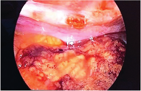 Hallazgo intraoperatorio en el que se observa el infarto del sector superior derecho del omento.