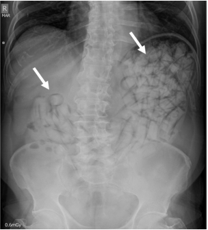 Radiografía de abdomen simple. Múltiples imágenes radiopacas en la cámara gástrica sugestivas de cuerpos extraños (flechas blancas).
