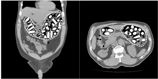 Tomografía computarizada contrastada de abdomen. A la izquierda (corte coronal) se observan imágenes hiperdensas cilíndricas sugestivas de cuerpos extraños en cámara gástrica (línea discontinua).