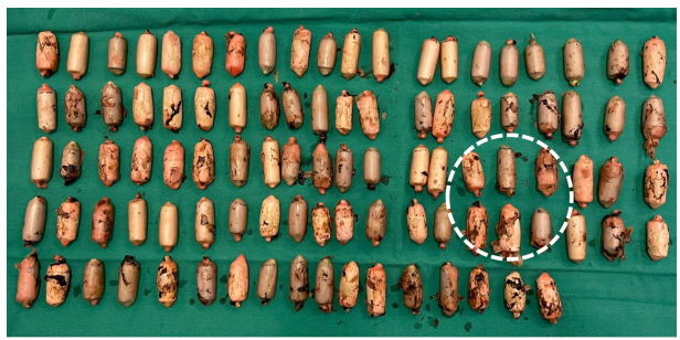 Múltiples cuerpos extraños en forma de dedo extraídos de la cavidad gástrica, con pérdida parcial de la cobertura de parafina (circulo blanco).