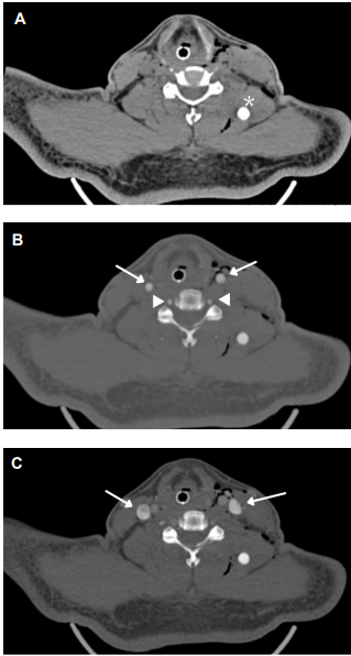 Im&aacute;genes axiales de TC simple y contrastada del cuello. A. En la fase simple se identifica un cuerpo extra&ntilde;o con morfolog&iacute;a redondeada (asterisco), hiperdenso (700 UH en promedio), de localizaci&oacute;n intramuscular paravertebral izquierda en cuello. B. En fase arterial se corrobora la integridad de las arterias car&oacute;tidas comunes (flechas) y vertebrales (puntas de flecha). C. Al igual se observan las estructuras venosas, como las yugulares internas (flechas), sin presentarse evidencia de sangrado activo.