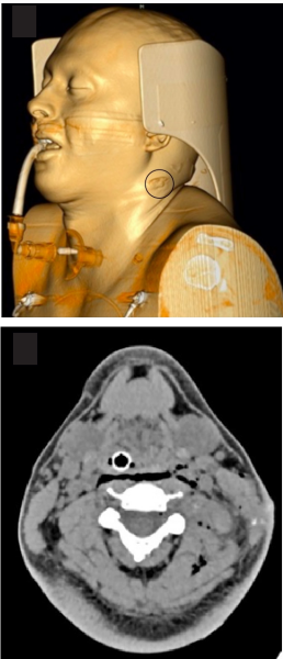 Enfisema presente en los tejidos blandos superficiales y profundos del lado izquierdo del cuello (incluyendo espacios retrofar&iacute;ngeo y carotideo, no correspondiente a la herida por el proyectil, el cual ingres&oacute; en la zona II del hemicuello izquierdo (circulo negro) con vector posteromedial. Este enfisema probablemente fue iatrog&eacute;nico por intubaci&oacute;n traum&aacute;tica.