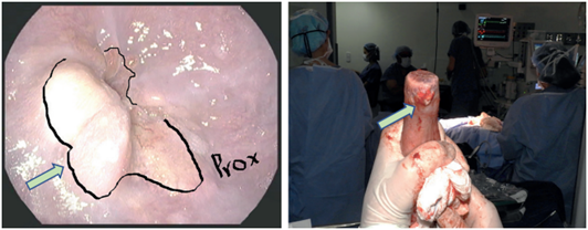 Imagen de correlaci&oacute;n endosc&oacute;pica y quir&uacute;rgica de un paciente con tumor de la uni&oacute;n gastroesof&aacute;gica Siewert II. Lesi&oacute;n tumoral se&ntilde;alada con las flechas.