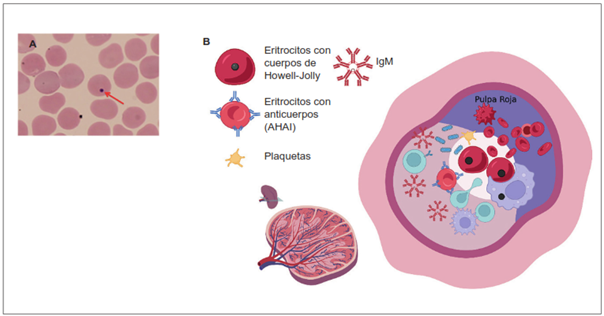 Funciones espl&eacute;nicas y cambios post-esplenectom&iacute;a. A. Se representan eritrocitos con cuerpos de Howell-Jolly. B. Entre las funciones del bazo, los macr&oacute;fagos remueven de manera fisiol&oacute;gica los eritrocitos que muestran inclusiones en su interior, depuran las bacterias o eritrocitos envejecidos. Este proceso origina la anemia hemol&iacute;tica autoinmune o la trombocitopenia inmune primaria.