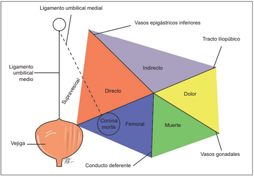 Triángulos de la región inguinal y espacio extraperitoneal.