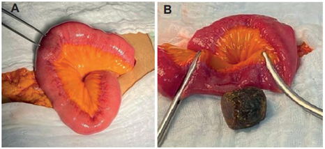 Fotograf&iacute;as intraoperatorias. A. La pinza de disecci&oacute;n se&ntilde;ala el c&aacute;lculo y permite apreciar su tama&ntilde;o en comparaci&oacute;n con el di&aacute;metro del &iacute;leon. B. C&aacute;lculo biliar extra&iacute;do de la luz intestinal mediante enterotom&iacute;a longitudinal en el borde antimesent&eacute;rico del &iacute;leon.