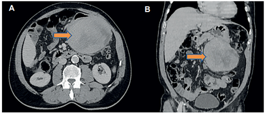 Tomografía computarizada de abdomen y pelvis contrastada, las flechas señalan la masa sólida heterogénea compatible con un tumor miofibroblástico inflamatorio gastrointestinal. A. corte axial. B. corte coronal.