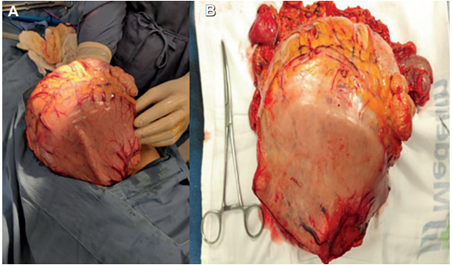 A. hallazgo intraoperatorio en bloque con el colon. B. espécimen quirúrgico del tumor miofibroblástico inflamatorio.
