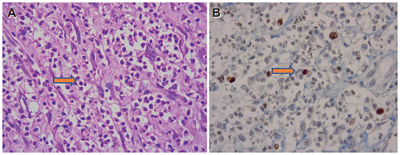 A. 40X, tinción de hematoxilina, la flecha señala las células neoplásicas grandes de núcleos densos, acompañadas de células inflamatorias. B. 40X, tinción de inmunohistoquímica con AML donde se resaltan las células neoplásicas (flechas).