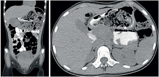 Tomograf&iacute;a computarizada donde se observa la c&aacute;mara g&aacute;strica distendida con una masa confluente, heterog&eacute;nea y de aspecto indeterminado.