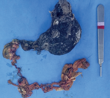 Tricobezoar con extensi&oacute;n al duodeno conformando el &ldquo;s&iacute;ndrome de Rapunzel&rdquo;.