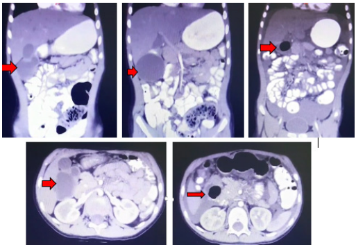 Tomograf&iacute;a computarizada donde se observa la imagen qu&iacute;stica entre el h&iacute;gado, ri&ntilde;&oacute;n derecho y colon. Se observa un h&iacute;gado normal y una ves&iacute;cula biliar distendida.