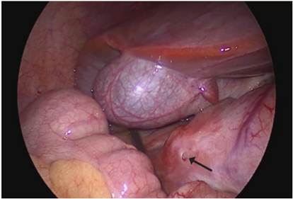 Vista laparosc&oacute;pica del quiste duodenal ubicado en la primera porci&oacute;n del duodeno, con un orificio de 2 mm (flecha) y con restos de moco.