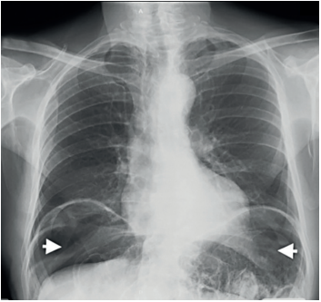 Radiograf&iacute;a de t&oacute;rax que muestra neumoperitoneo bilateral (cabeza de flecha).