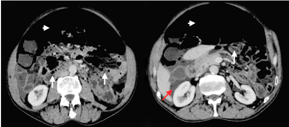 Tomograf&iacute;a computarizada de abdomen donde se observa neumoperitoneo (cabeza de flecha), m&uacute;ltiples im&aacute;genes redondeadas localizadas en la pared del intestino delgado con densidad de aire (flechas blancas) y l&iacute;quido libre intraabdominal (flecha roja).