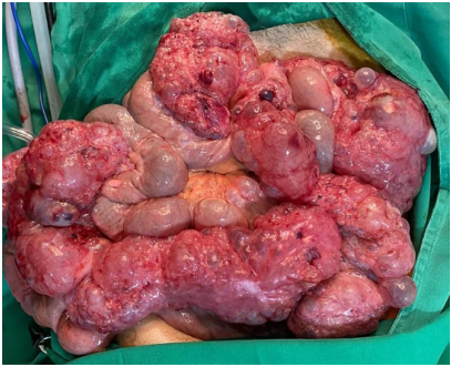 Hallazgo intraoperatorio de neumatosis intestinal masiva del &iacute;leon.