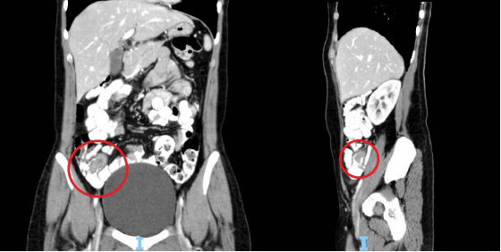 Tomograf&iacute;a computarizada de abdomen. A la izquierda, corte coronal con signo de doble halo e inflamaci&oacute;n de las paredes del ciego sin poder identificar el ap&eacute;ndice. A la derecha, corte sagital donde se observa la invaginaci&oacute;n parcial del ap&eacute;ndice hacia el ciego, que impide el ingreso del medio de contraste.