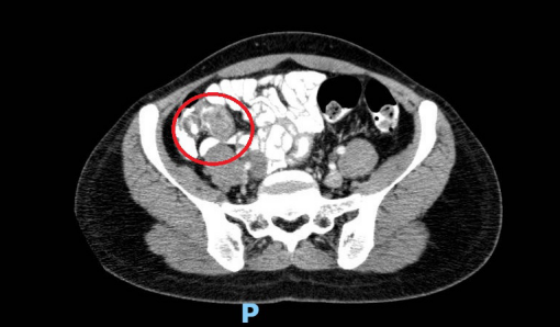 Tomograf&iacute;a computarizada de abdomen, corte axial donde se observa el signo de la doble diana, inflamaci&oacute;n de la grasa pericecal, y sin paso del medio de contraste al ciego, en el sitio de la invaginaci&oacute;n.